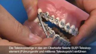 SUS² - Eine intermaxilläre festsitzende Teleskopapparatur mit integrierter Feder