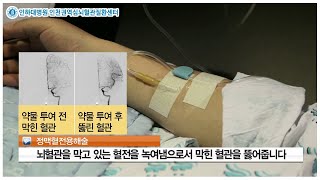 [뇌혈관을 부탁해] 혈전용해술