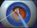 animated video of cataract motibindu surgery by asian eye hospital pune dr vardhaman kankariya