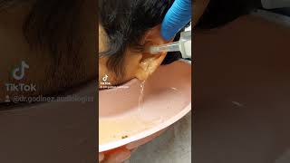 Earwax removal (irrigation or syringing and/or lavage)