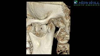 Temporomandibular Joints