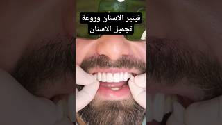 فينير الاسنان وقشور السيراميك من أجل اجمل ابتسامة هوليود