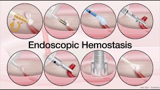 GI Lecture Series - UGI Bleeding - Peptic Ulcer Bleeding Endoscopic Therapy