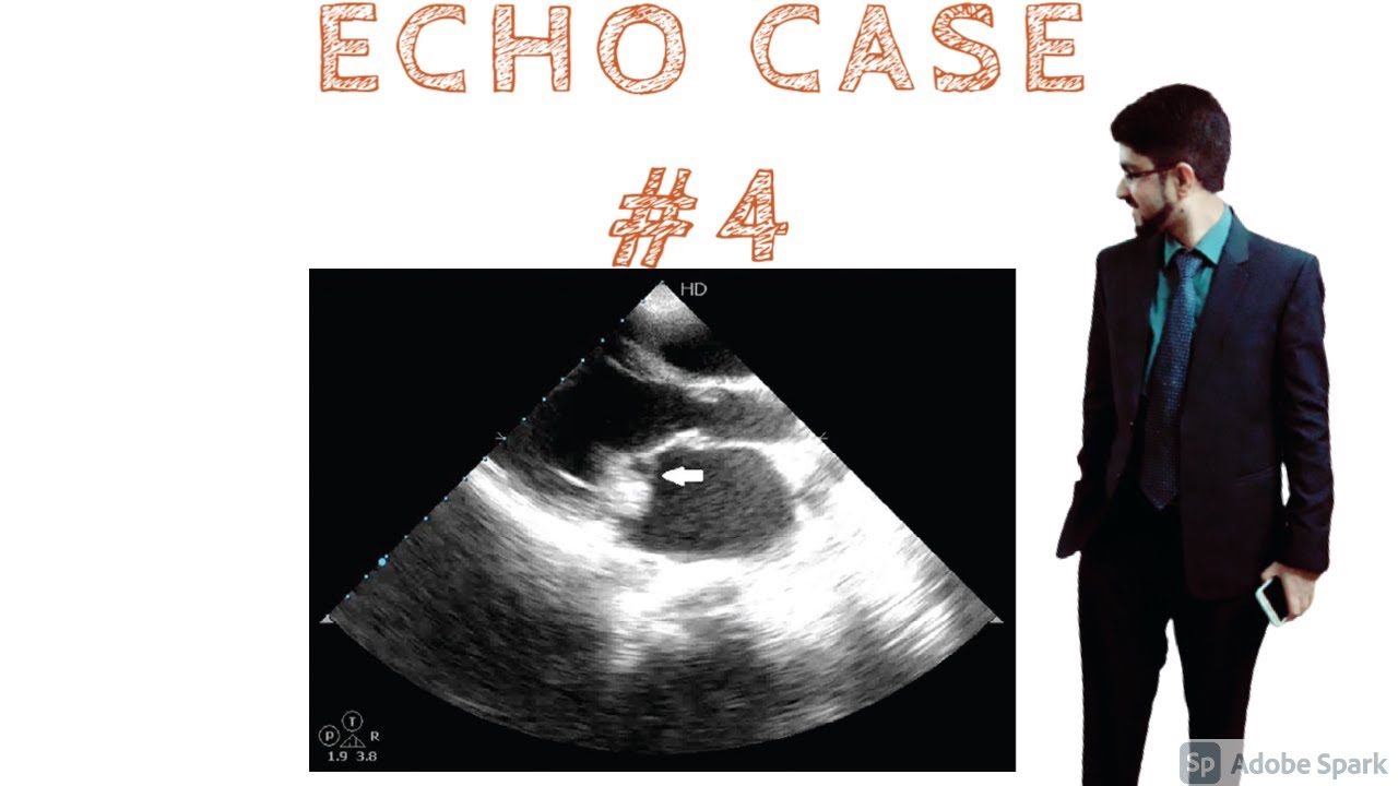 Echo Cases Case 4 Echocardiography Educational Video Youtube