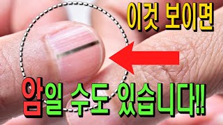 손톱에 '이것'보이면 빨리 병원에 가야 하는 이유!! 손톱으로 보는 건강상태!!