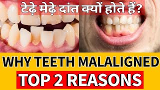 आखिर क्यों होते हैं टेढ़े-मेढ़े दांत | Why you have crooked teeth |