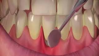 Sensitive Teeth Treatment | Rajandental