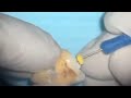 Apical gauging || How to select master cone Gutta percha ( fitting master cone)