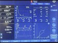 adaptive support ventilation a case of high minute ventilation