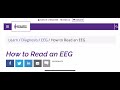 How to Read an EEG (Epilepsy Foundation)