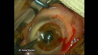 Tectonic and therapeutic penetrating keratoplasty (PKP)