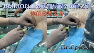 BMI 30以上の腰部硬膜外麻酔2例（体位の考え方）epidural anesthesia by Dr.EpiCal