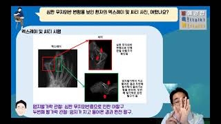 {발톡!}, 아탈구가 동반된 무지외반증의 수술적 치료.