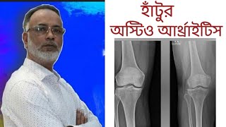 হাঁটুতে ব্যথা এবং অস্টিও আর্থ্রাইটিস | Knee Pain and Knee Osteoarthritis | M Anwar Hossain