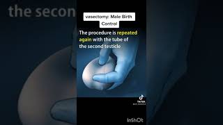 Vasectomy male birth control| How Vasectomy is done animetion