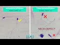 Teratozoospermia - Poor Morphology Sperms Comparison with Normal morhology sperms - Normozoospermia