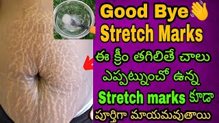 పర్మినెంట్ గా మీ Stretch Marks ని ఈ ఒక్క క్రీమ్ తో ఈజీగా తొలగించు కోవచ్చు | 100% Working Home Remedy