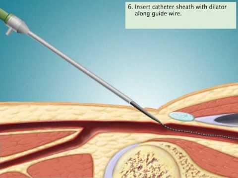 Cardiac Catheterization Via Femoral Artery - YouTube