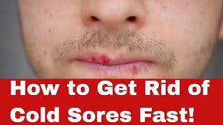 Discover the Secret: How to Get Rid of Cold Sores Fast!