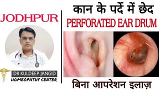 Best homoeopathy treatment of perforated ear drum । कान के पर्दे में छेद का बिना ऑपेरशन इलाज़ ।