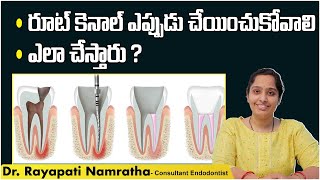 రూట్ కెనాల్ ఎలా చేస్తారు | Root Canal Treatment Procedure in Telugu | Dr Namratha | Eledent Hospital