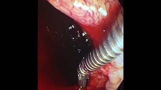A novel, duodenoscope-friendly endoscopic clip for treating massive upper-GI bleeding