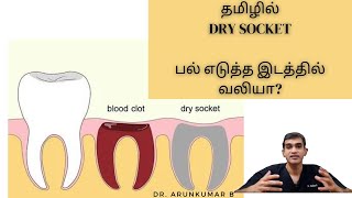 தமிழில் Dry Socket |  பல் எடுத்த இடத்தில வலியா? Dr Arunkumar Pearls Dentistry | Dental Clinic India