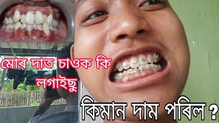 Dental braces/কিমান দাম পৰিল?/Braces treatment কেনেকৈ হয় ??