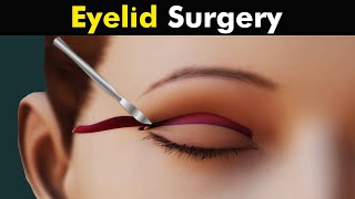 How Blepharoplasty is performed? Eyelid surgery Animation