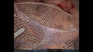 Routine Robotic TAPP Right inguinal hernia repair with mesh \u0026 pocket evacuation with cannula