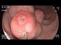 Endoscopic Duodenal and Fundal Variceal Glue injection by Dr Sunil D Popat