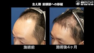 【植毛4ヶ月後 生え始め】生え際 前頭部に2000株移植「1年後、他のヘアスタイルにも挑戦したい!」【 新宿・名古屋・大阪・福岡 】