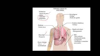 Aula Leucemias Agudas