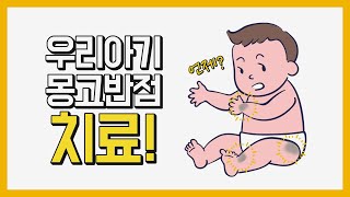 아기 몽고반점 치료 언제부터 가능? 성인도 짙은 몽고 반점 치료 #몽고반점