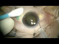 Anterior chamber  or aqueous tap in phakic eye