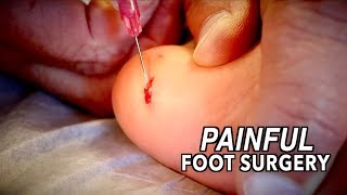 PAINFUL FOOT SURGERY! (We Had To Operate Fast) | Dr. Paul