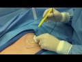 male breast on one side unilateral gynecomastia austin gynecomastia center