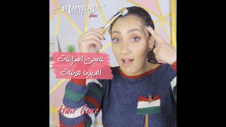 marian samir - عالجي الفراغات الديرما للانبات