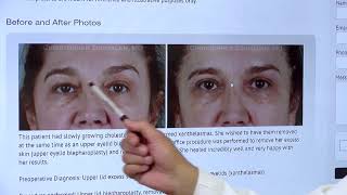 Benign Eyelid Lesions Beverly Hills