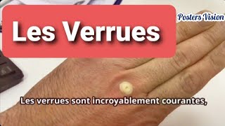 Les Verrues: Traitement selon le siège: plantaires visage astuce pour enlever Azote liquide