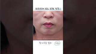 [10초만에 보는 성형전후] 팔자주름 필러 1개월차 #shorts