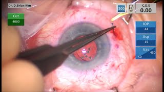 Intrascleral Haptic Fixation Yamane Flanged Technique Second Try