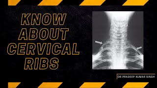 Know About Cervical Ribs/ Thoracic Outlet Syndrome /Dr. Pradeep Kumar Singh