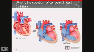 Demystifying Medicine 2016: Progress in Understanding Congenital Heart Disease