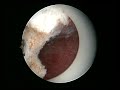 hysteroscopy art complete uterine cervical septum resection.mpg