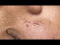 Huyen phan treantment acne #113 #acne #mun #nanmun #treatment #trending #huyenphantrimun #goldspa