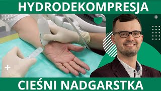 Hydrodekompresja cieśni nadgarstka - nieoperacyjna metoda leczenia - lek. Tomasz Grądzki