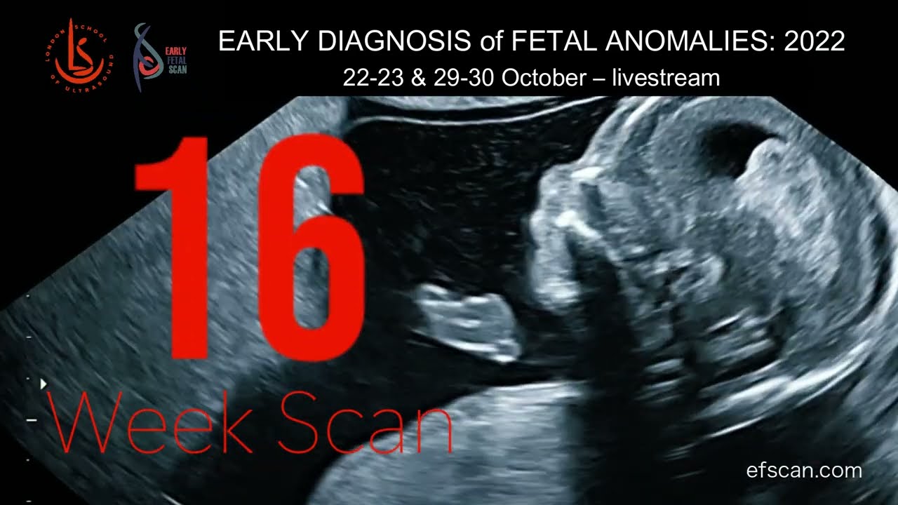 16 Week Anomaly Scan - EARLY DIAGNOSIS Of FETAL ANOMALIES 2022 - YouTube