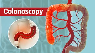 What happens during a Colonoscopy? | Colonoscopy Procedure | 3D Animation | ERemedium