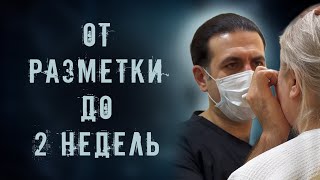 Омоложение лица: От разметки до 2 недель